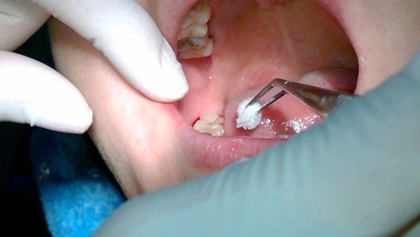 Niềng răng có nhất định phải nhổ răng khôn không?
