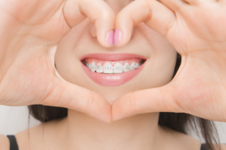 Niềng răng sứ và kim loại – nên chọn phương pháp nào?