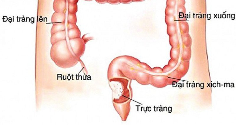 U trực tràng: Những điều cần biết | Vinmec