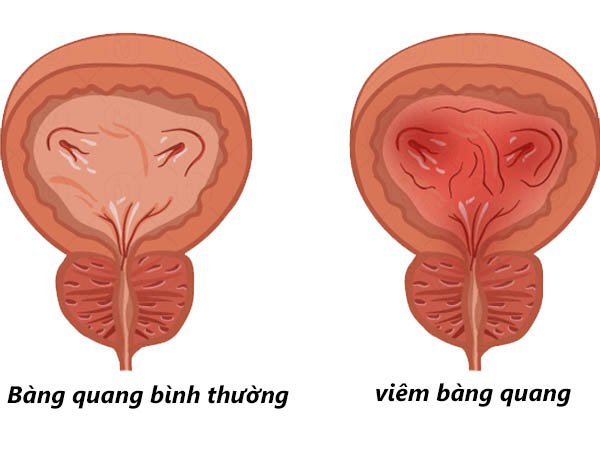 Hiện tượng xuất huyết ở bàng quang | Vinmec