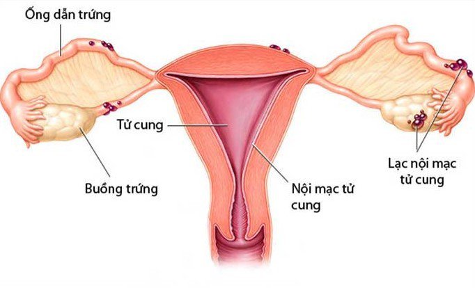 Lạc nội mạc tử cung - Nên làm gì để kiểm soát bệnh - Buồng Trứng Đa Nang
