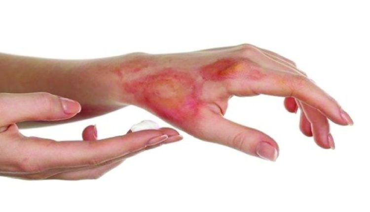 Bỏng là tổn thương thường gặp trong cuộc sống sinh hoạt và lao động Bỏng là tổn thương thường gặp trong cuộc sống sinh hoạt và lao động