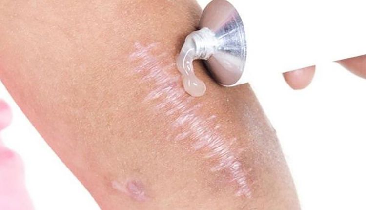 Nên dùng gel trị sẹo đúng thời điểm để phát huy tác dụng 