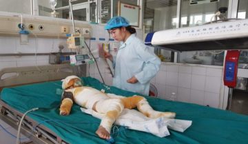 Bị bỏng cồn phải làm sao? Nguyên nhân và cách điều trị Bị bỏng cồn phải làm sao? Nguyên nhân và cách điều trị