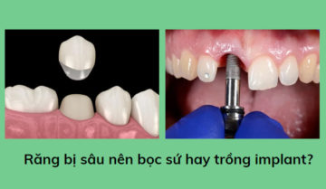 Răng bị sâu nên bọc sứ hay trồng răng? Răng bị sâu nên bọc sứ hay trồng răng?