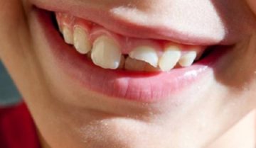 Chấn thương răng ở trẻ em: Nhận biết, xử lý và phòng ngừa hiệu quả Chấn thương răng ở trẻ em: Nhận biết, xử lý và phòng ngừa hiệu quả