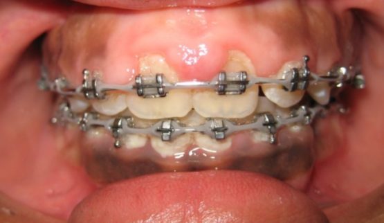 Niềng răng bị tụt lợi: Nguyên nhân, dấu hiệu và cách điều trị Niềng răng bị tụt lợi: Nguyên nhân, dấu hiệu và cách điều trị