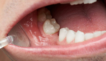 Tiêu xương ổ răng sau khi nhổ răng Tiêu xương ổ răng sau khi nhổ răng