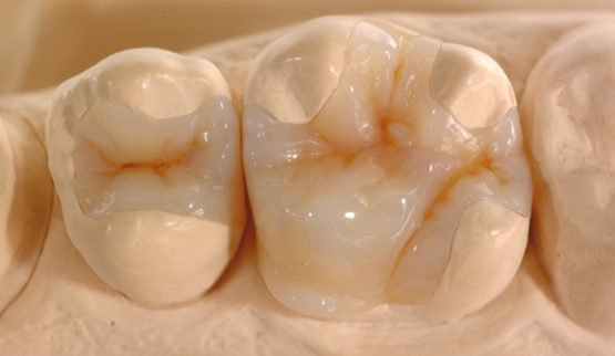 Vật liệu trám composite: cấu tạo và độ bền thực tế Vật liệu trám composite: cấu tạo và độ bền thực tế