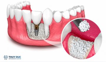 Ghép xương răng trong nha khoa – vật liệu và quy trình Ghép xương răng trong nha khoa – vật liệu và quy trình