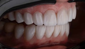 Răng sứ có tẩy trắng được không? Răng sứ có tẩy trắng được không?