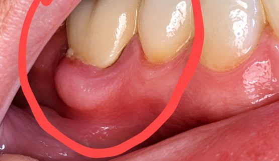 Nhiễm trùng sau bọc răng sứ phải làm sao?