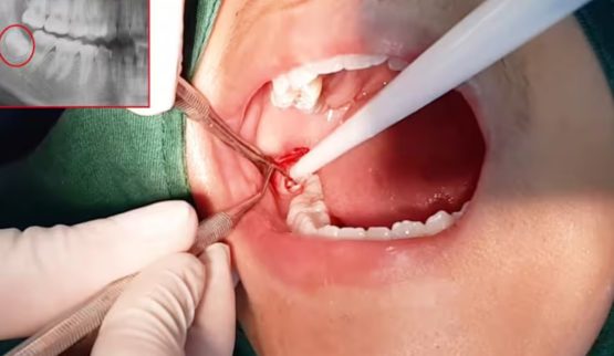 Nhổ răng khôn nên nhổ mấy cái? Nhổ răng khôn nên nhổ mấy cái?
