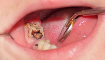 Răng sâu nặng có bọc sứ được không? Răng sâu nặng có bọc sứ được không?