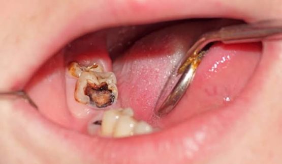Răng sâu nặng có bọc sứ được không? Răng sâu nặng có bọc sứ được không?