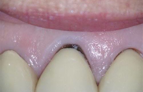 Nguyên nhân khiến răng sứ bị hở chân răng Nguyên nhân khiến răng sứ bị hở chân răng