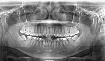 Vì sao răng bọc sứ bị viêm tủy, chữa như thế nào?