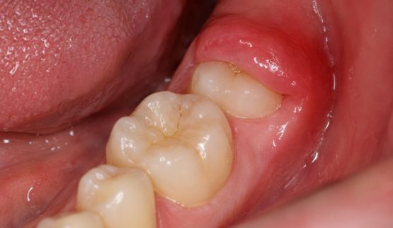 Răng khôn mọc thẳng có nên nhổ không? Răng khôn mọc thẳng có nên nhổ không?